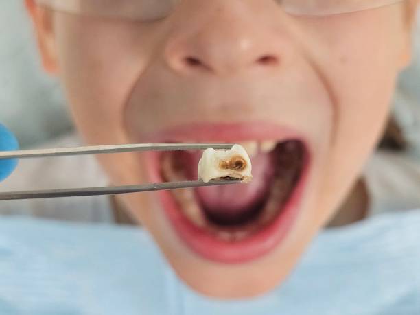 Best Emergency Tooth Extraction in Acworth, GA